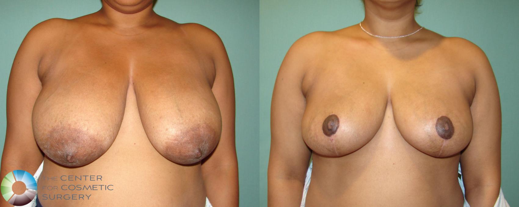 Before & After Breast Reduction Case 678 View #1 View in Denver & Golden, CO