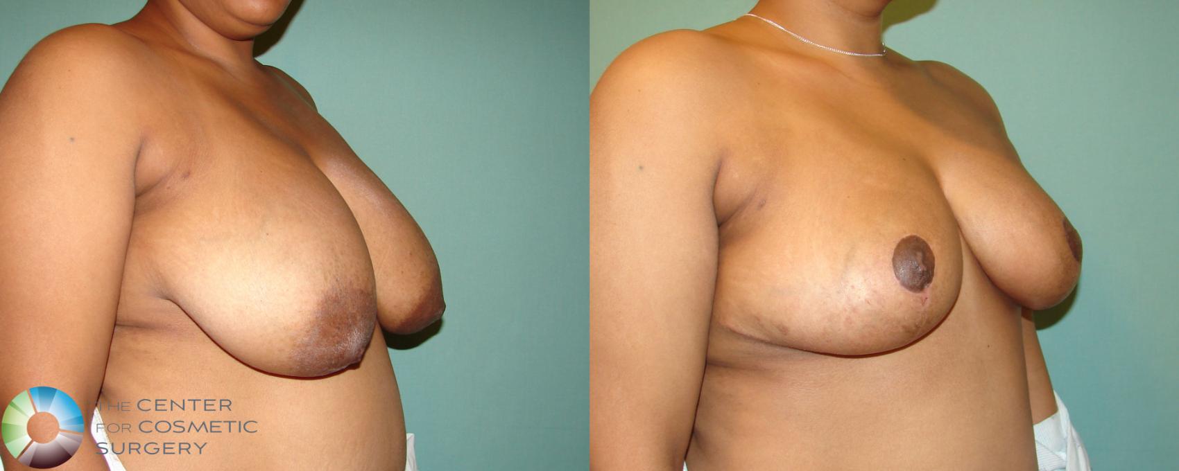 Before & After Breast Reduction Case 678 View #2 View in Denver & Golden, CO