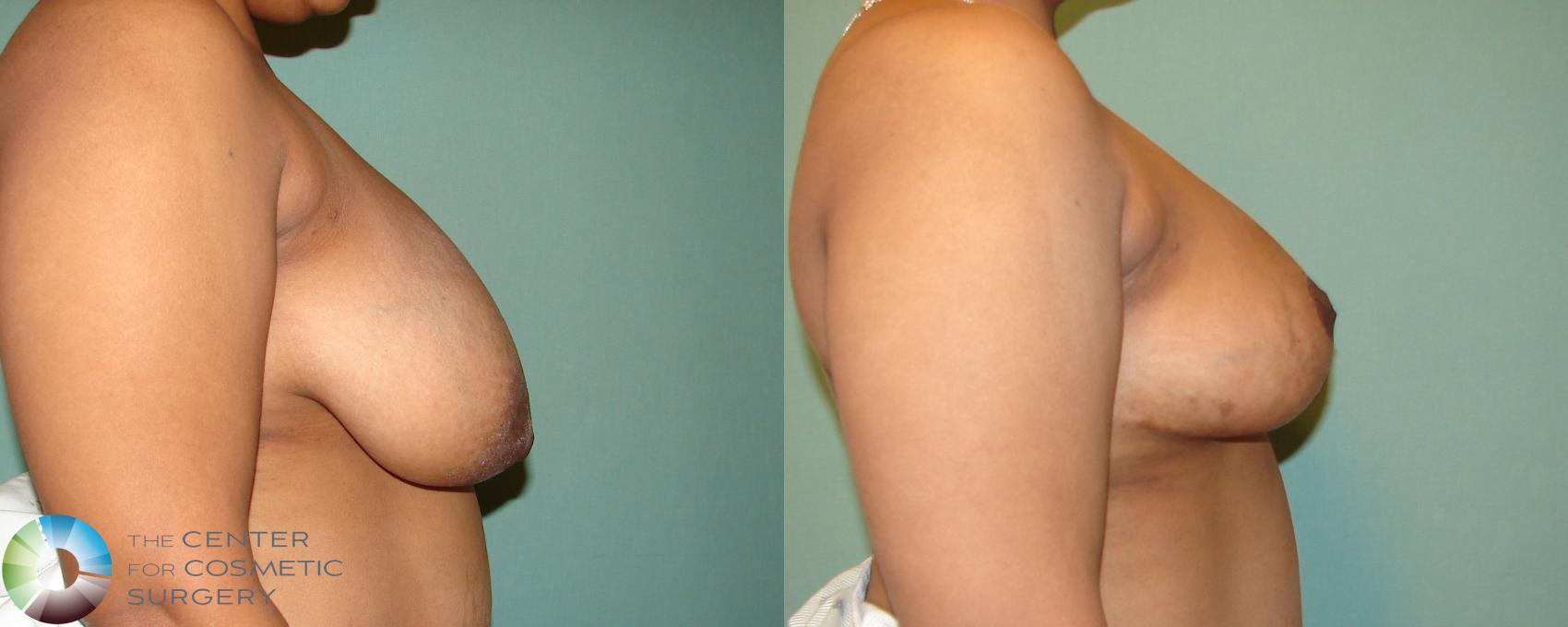 Before & After Breast Reduction Case 678 View #3 View in Golden, CO