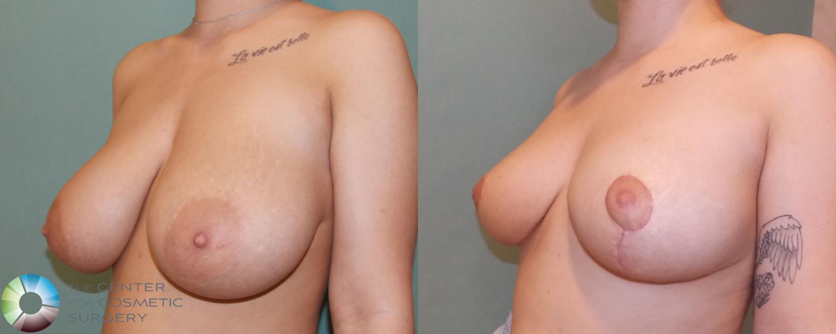 Before & After Breast Reduction Case 692 View #1 in Denver and Colorado Springs, CO