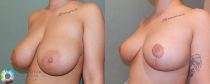 Before & After Breast Reduction Case 692 View #1 in Denver and Colorado Springs, CO
