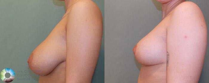 Before & After Breast Reduction Case 692 View #2 in Denver and Colorado Springs, CO