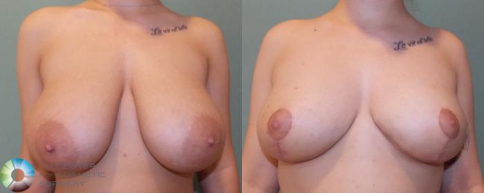 Before & After Breast Reduction Case 692 View #3 in Denver and Colorado Springs, CO