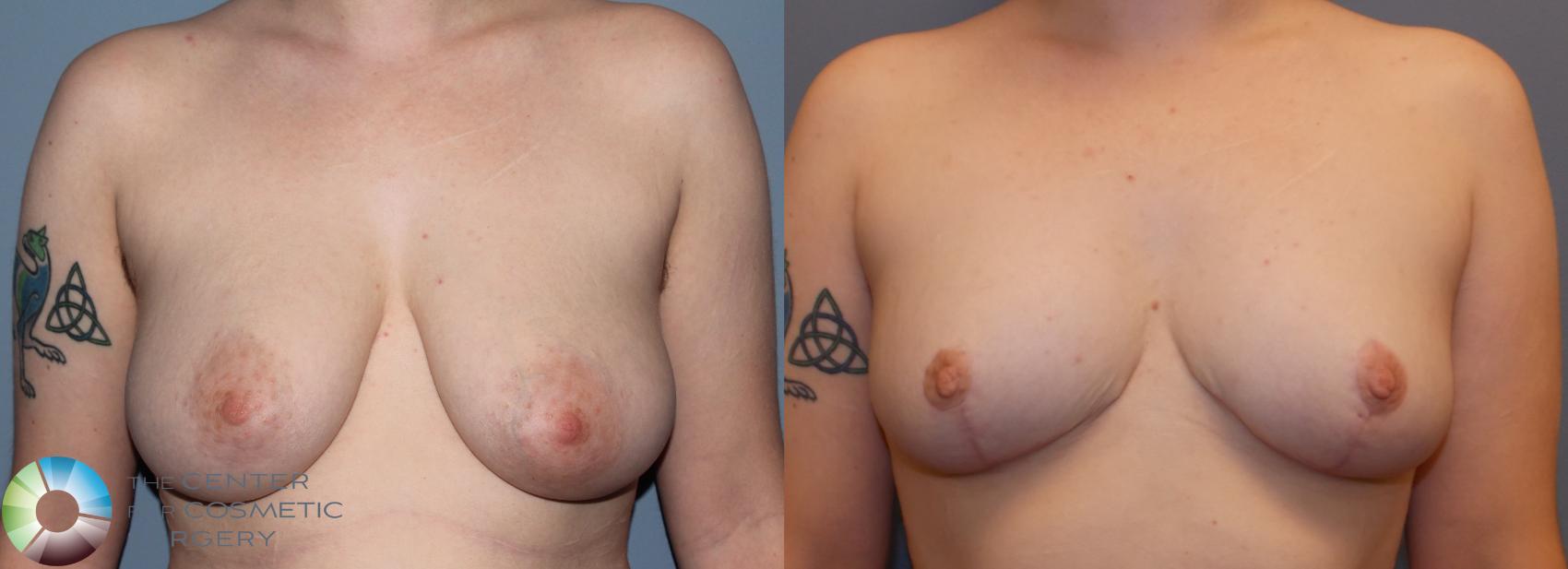 Before & After Breast Reduction Case 861 View #1 in Denver and Colorado Springs, CO