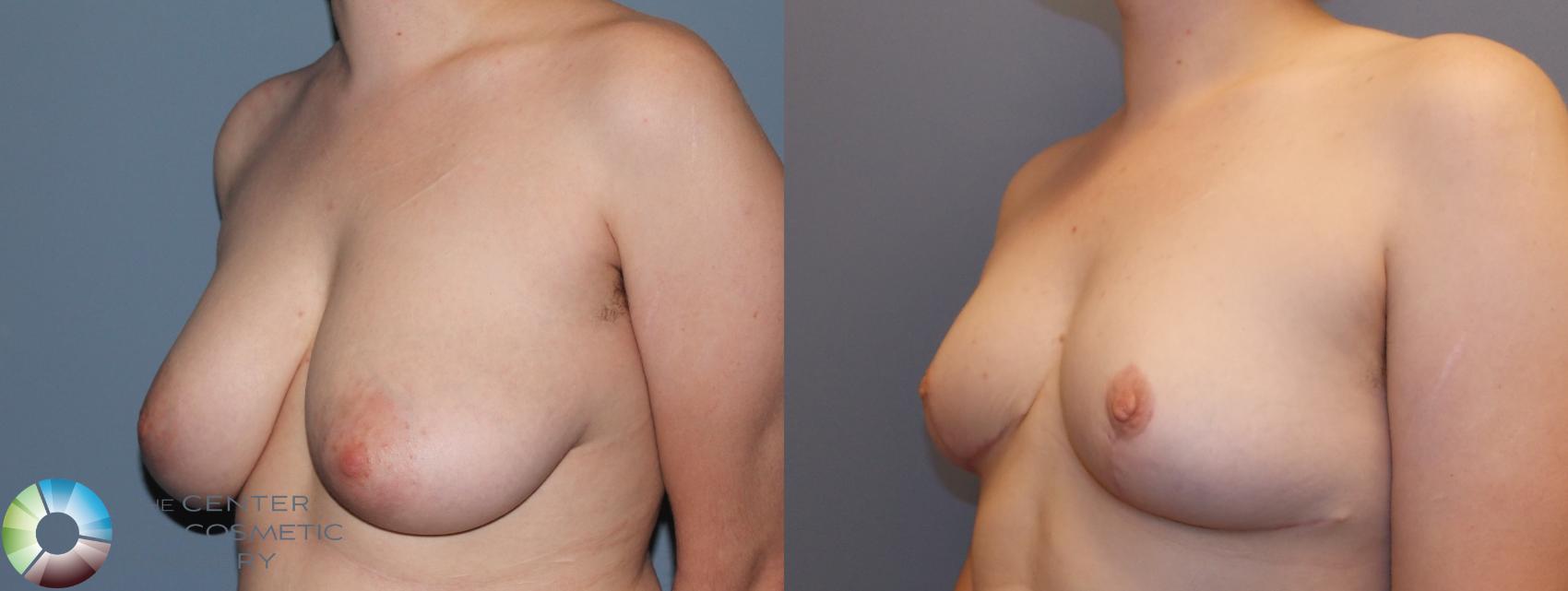 Before & After Breast Reduction Case 861 View #2 View in Golden, CO