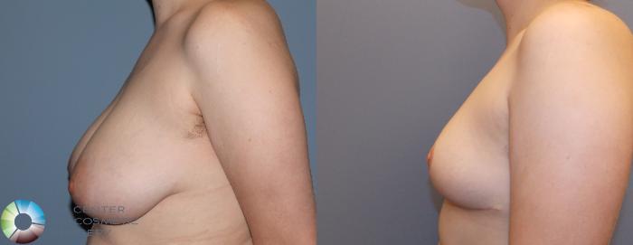 Before & After Breast Reduction Case 861 View #3 View in Golden, CO