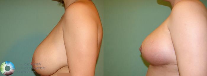 Before & After Breast Reduction Case 894 View #2 in Denver and Colorado Springs, CO