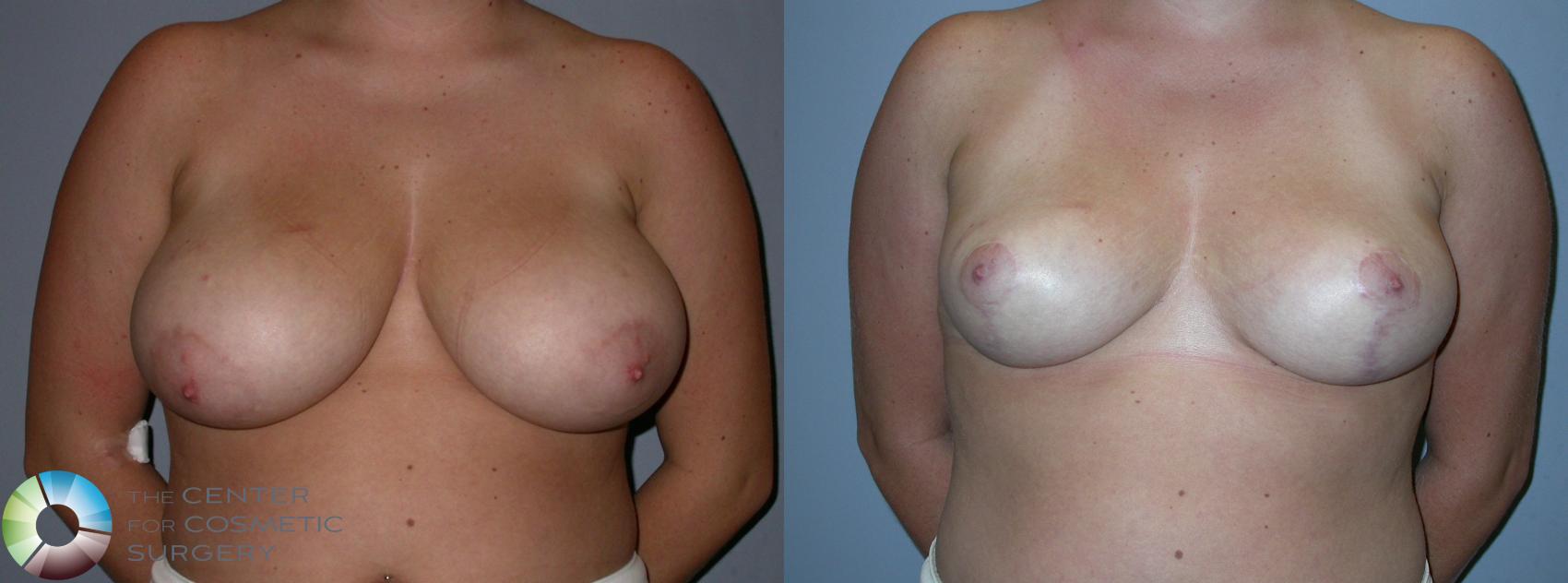 Before & After Breast Reduction Case 91 View #1 View in Denver & Golden, CO