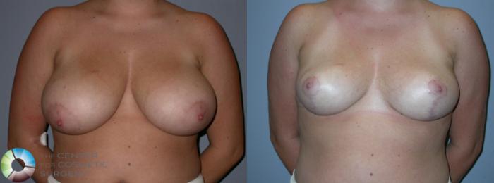 Before & After Breast Reduction Case 91 View #1 View in Golden, CO