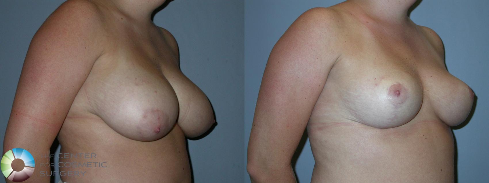 Before & After Breast Reduction Case 91 View #2 View in Denver & Golden, CO