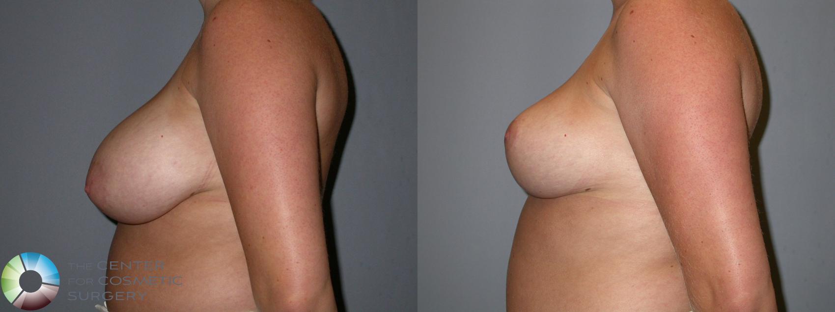 Before & After Breast Reduction Case 91 View #3 View in Denver & Golden, CO