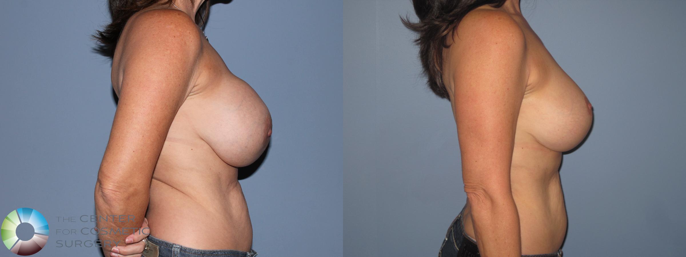 Before & After Breast Implant Revision Case 11303 Right Side View in Denver & Golden, CO