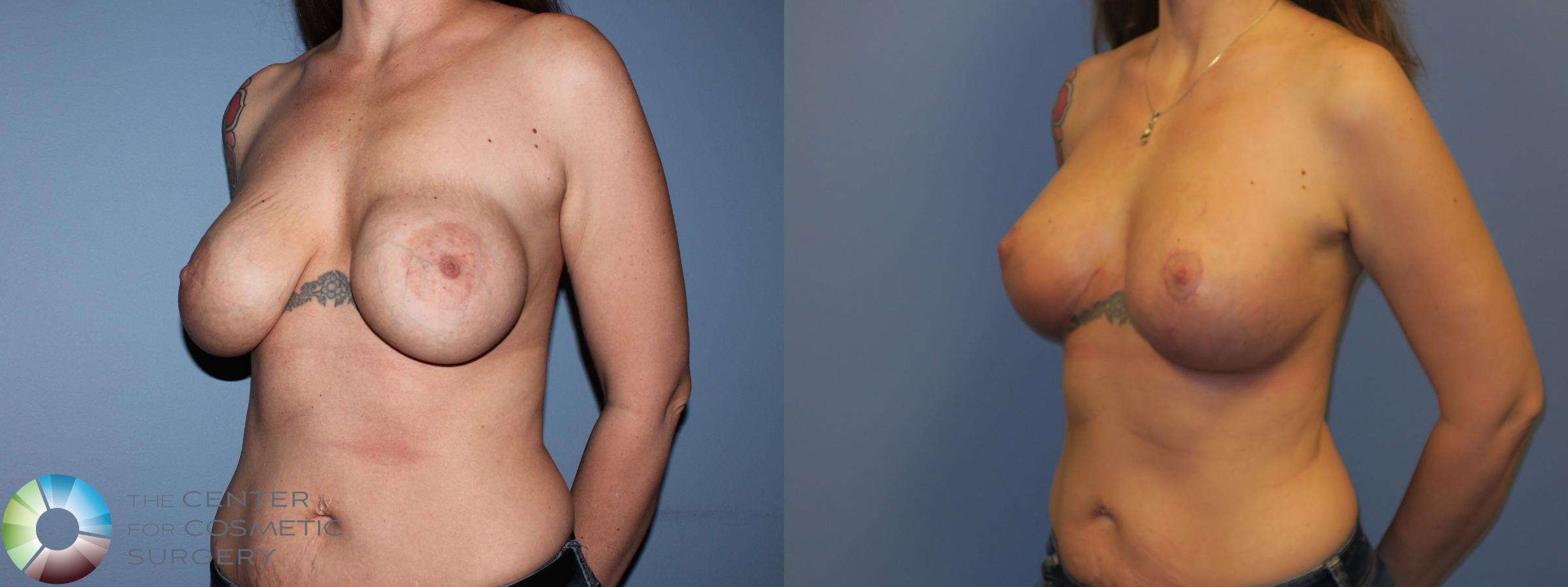 Before & After Breast Implant Revision Case 11304 Left Oblique View in Denver & Golden, CO