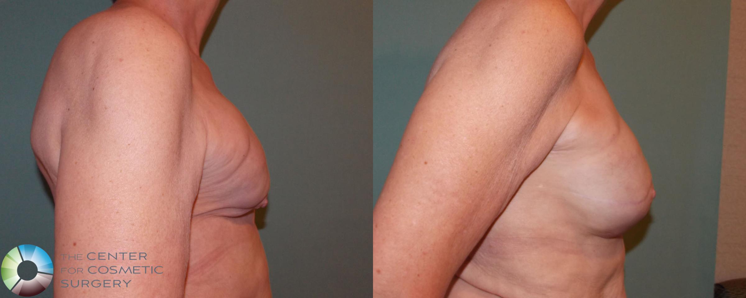 Before & After Breast Implant Revision Case 688 View #3 View in Denver & Golden, CO