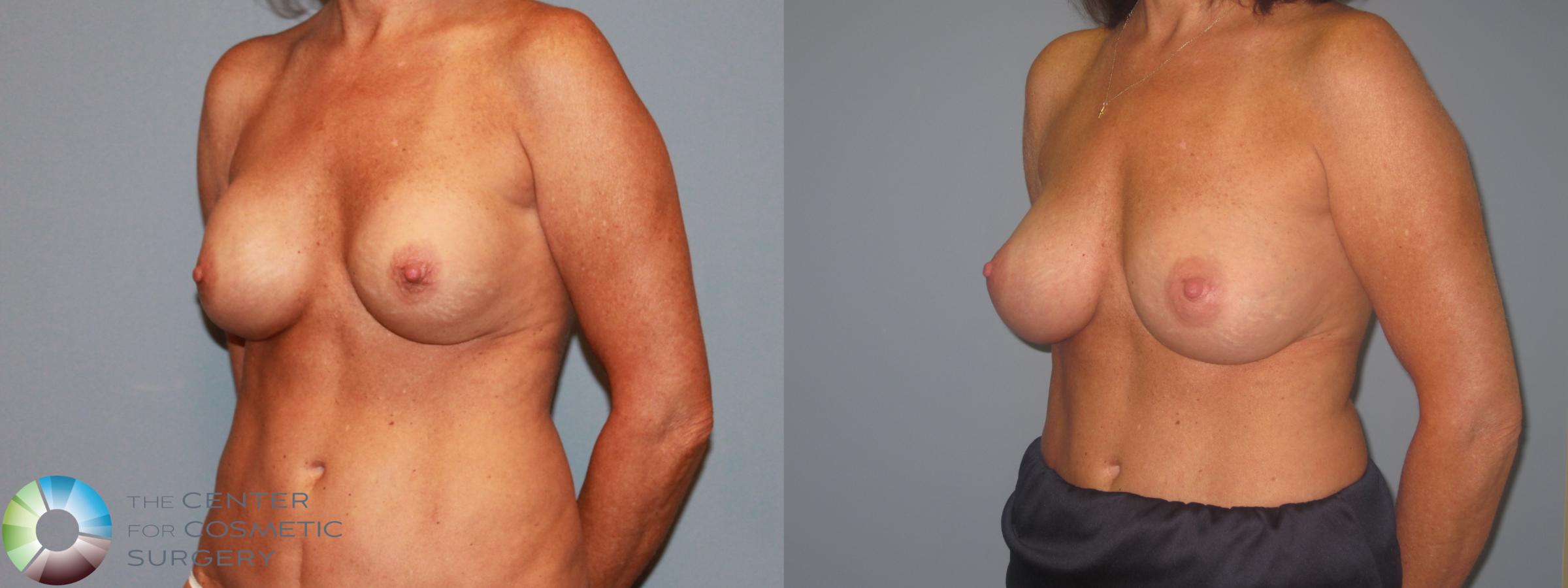 Before & After Breast Implant Revision Case 713 View #4 View in Denver & Golden, CO