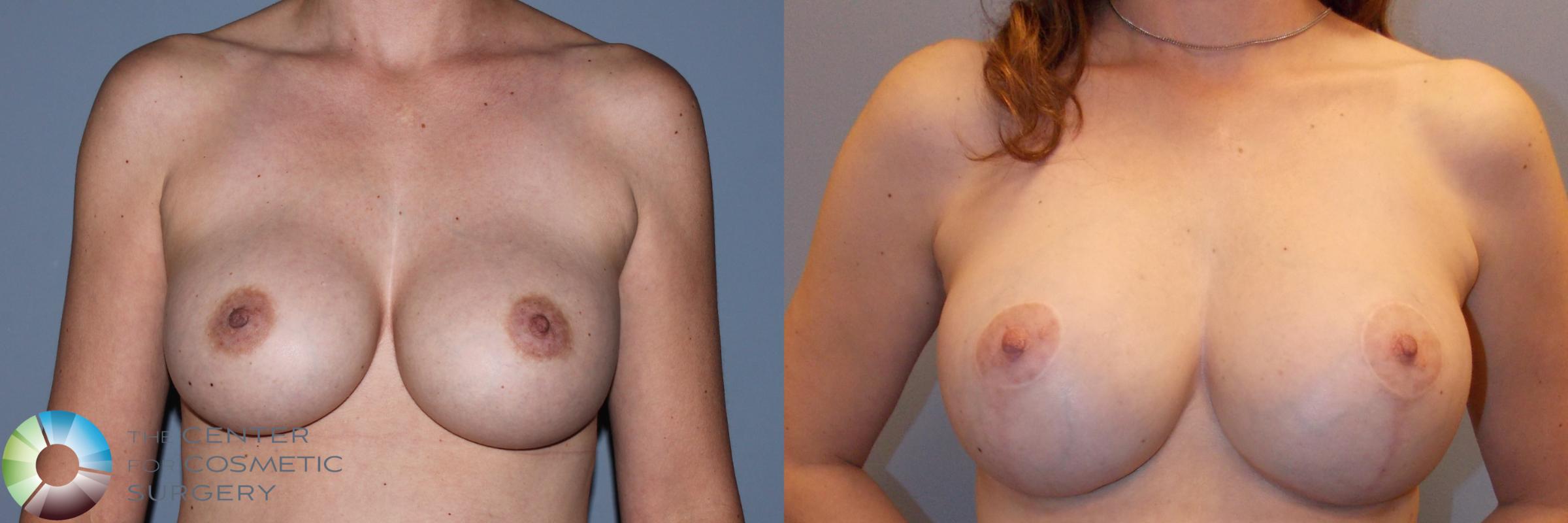Breast Revision Case 784 Before & After View #1 | Golden, CO | The Center for Cosmetic Surgery