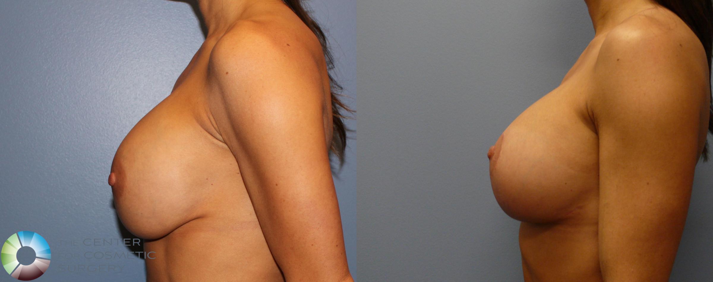 Before & After Breast Implant Revision Case 904 View #3 View in Denver & Golden, CO