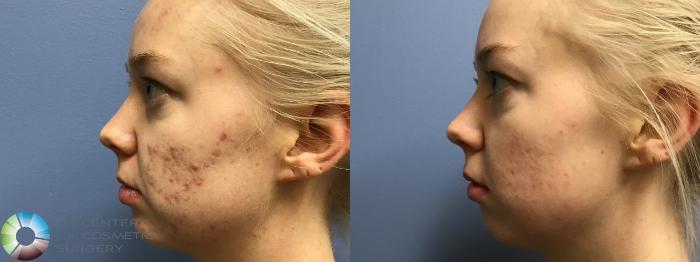 Before & After Chemical Peels/Microdermabrasion Case 11598 Left Side View in Golden, CO