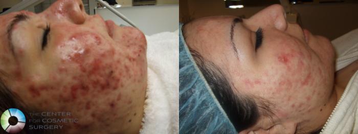 Before & After Chemical Peels/Microdermabrasion Case 277 View #2 View in Golden, CO