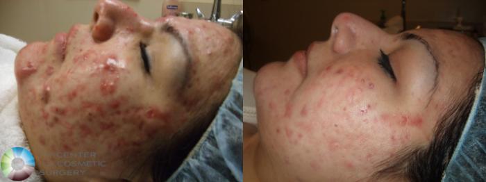Before & After Chemical Peels/Microdermabrasion Case 277 View #3 View in Golden, CO