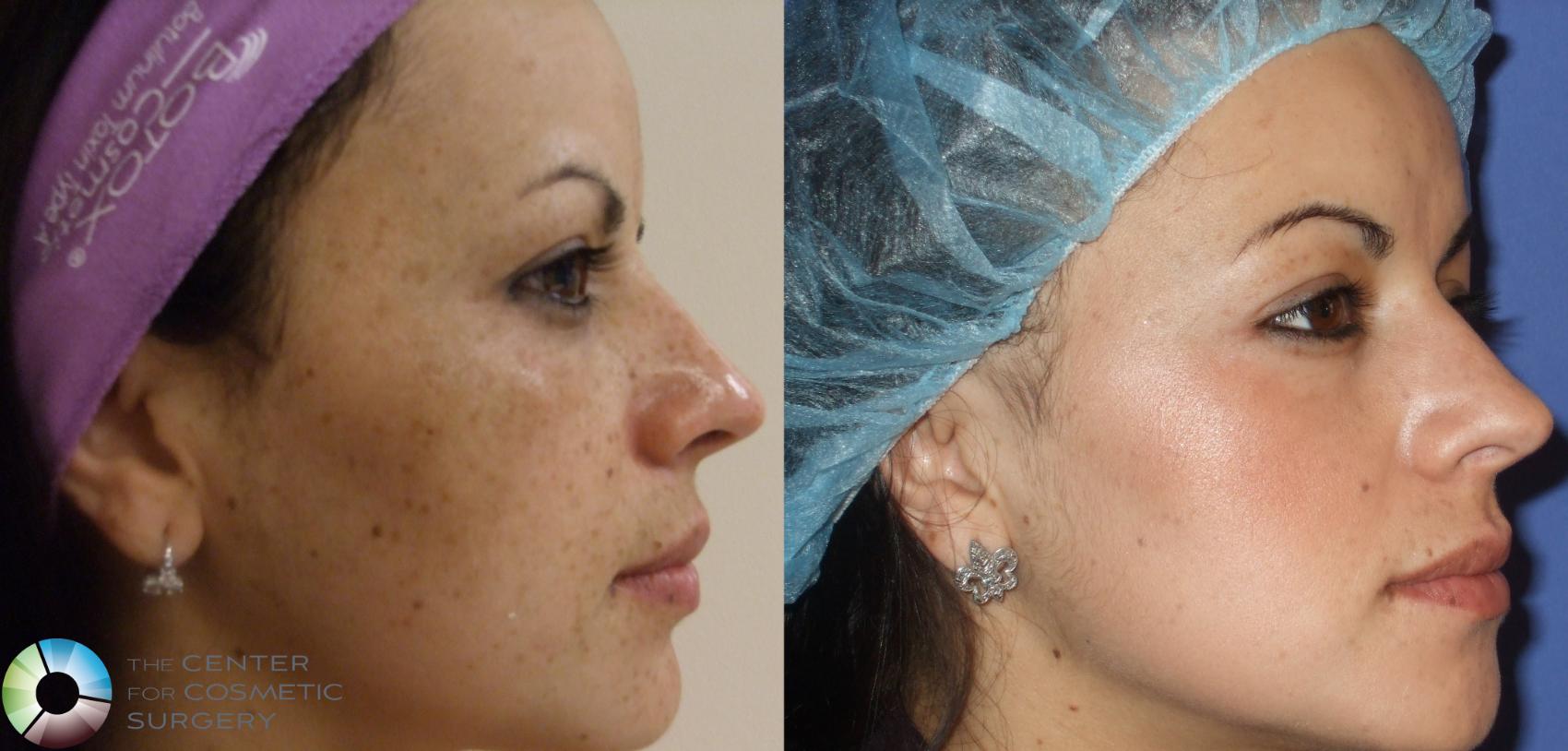 Before & After Chemical Peels/Microdermabrasion Case 295 View #1 in Denver, CO