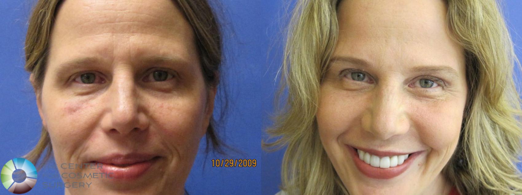 Before & After Chemical Peels/Microdermabrasion Case 383 View #1 in Denver, CO