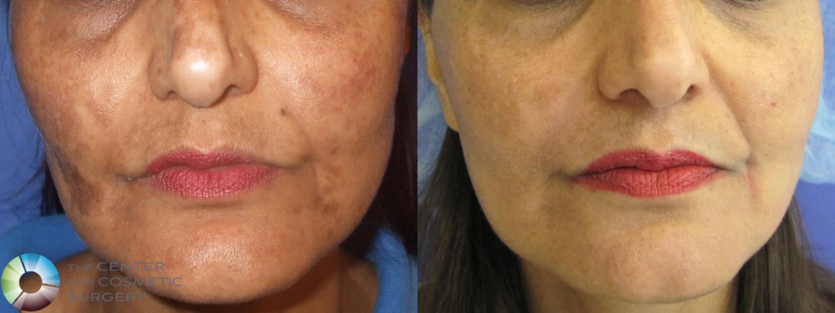 Before & After Chemical Peels/Microdermabrasion Case 385 View #1 View in Golden, CO