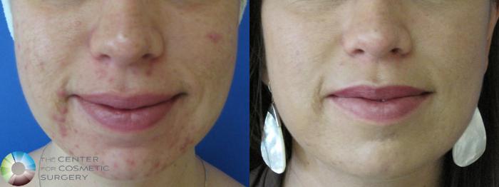 Before & After Chemical Peels/Microdermabrasion Case 386 View #1 View in Golden, CO