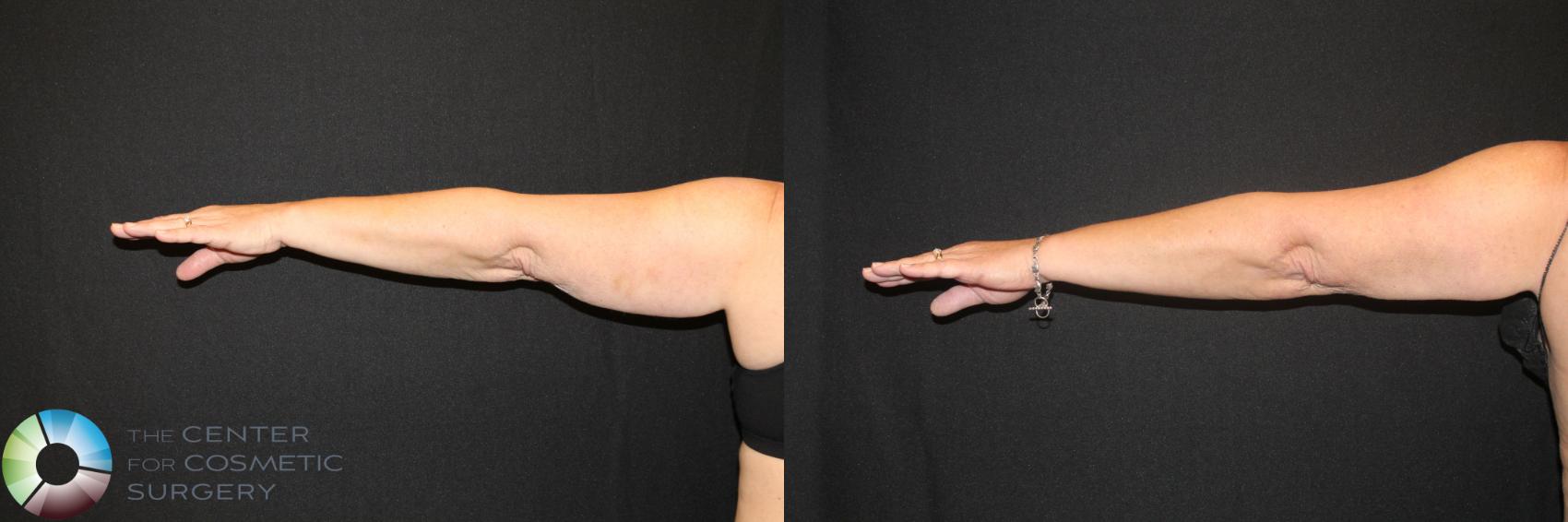 Before & After CoolSculpting Case 723 View #1 in Denver and Colorado Springs, CO