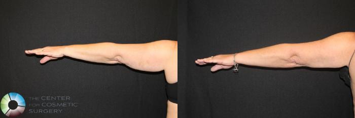 Before & After CoolSculpting Case 723 View #1 View in Golden, CO