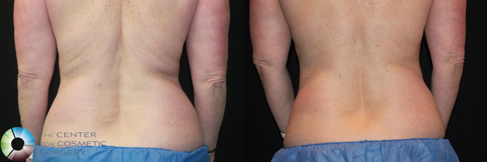 Before & After CoolSculpting Case 724 View #1 in Denver and Colorado Springs, CO