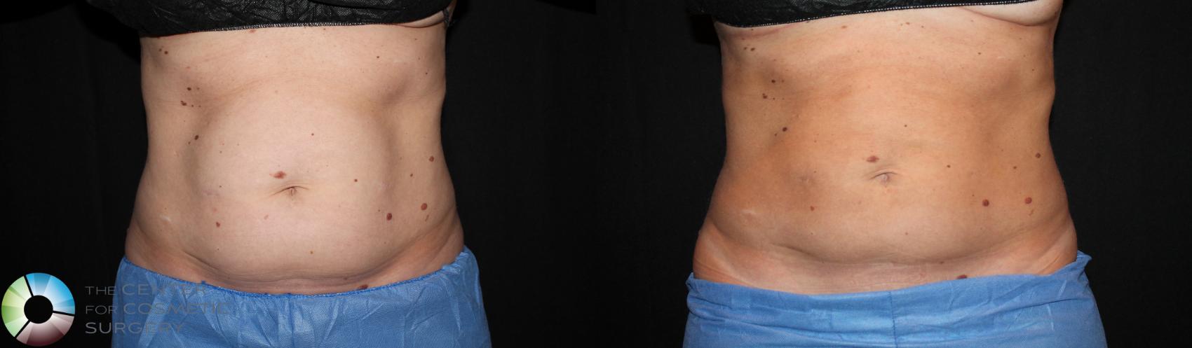 Before & After CoolSculpting Case 725 View #1 in Denver and Colorado Springs, CO