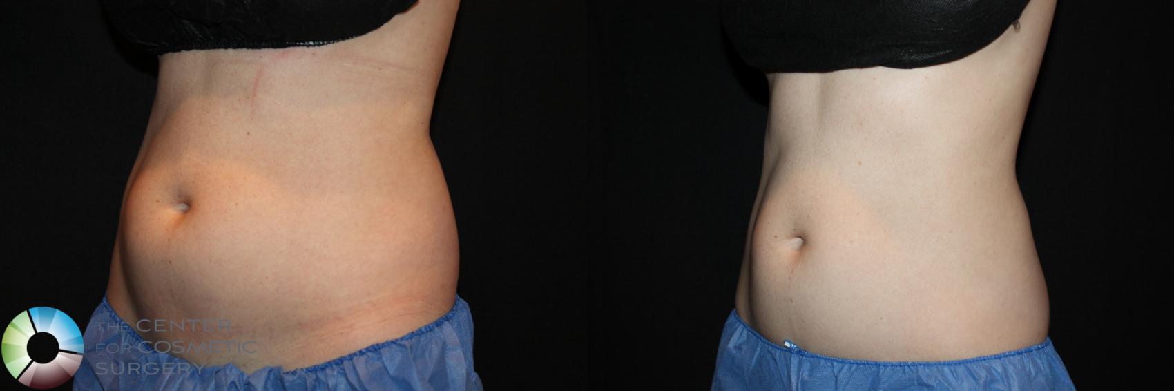 Before & After CoolSculpting Case 726 View #1 in Denver and Colorado Springs, CO