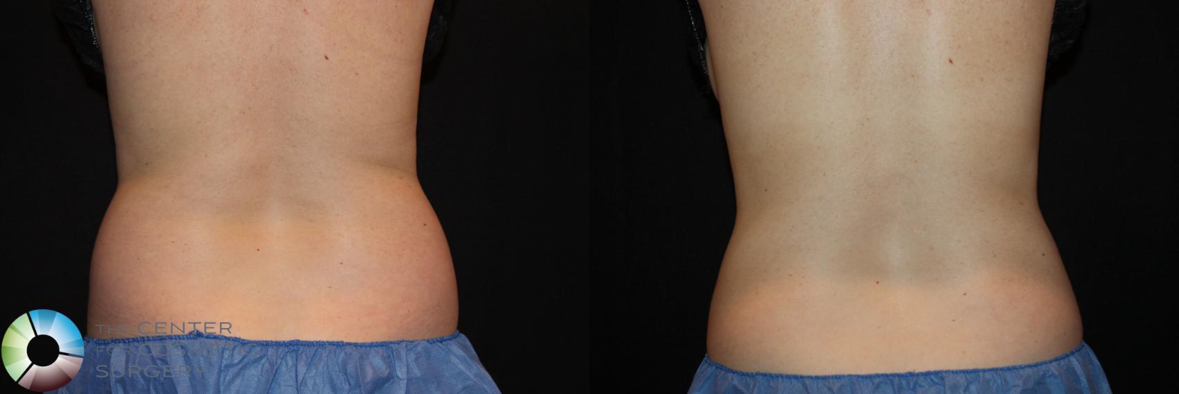 Before & After CoolSculpting Case 726 View #2 View in Golden, CO