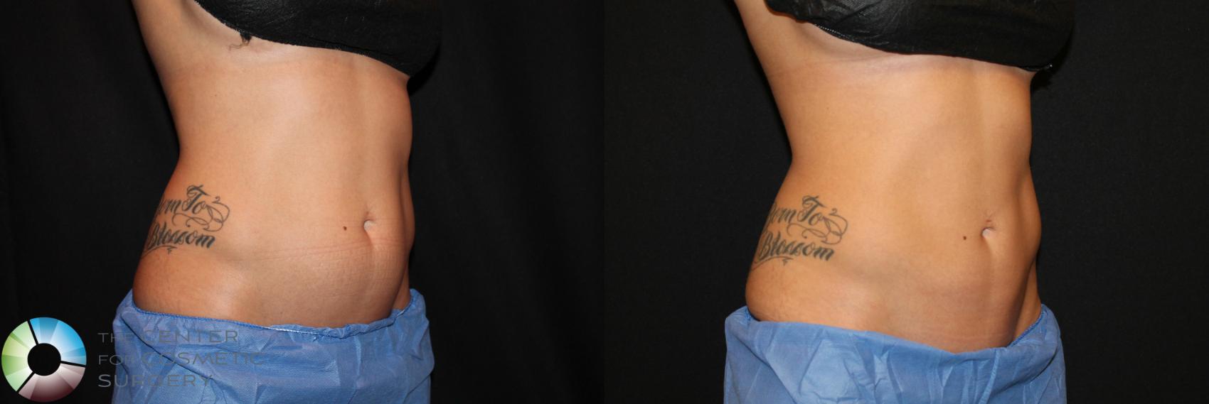 Before & After CoolSculpting Case 728 View #1 in Denver and Colorado Springs, CO