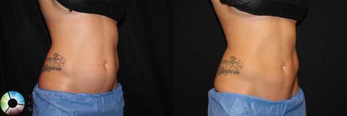 Before & After CoolSculpting Case 728 View #1 View in Golden, CO