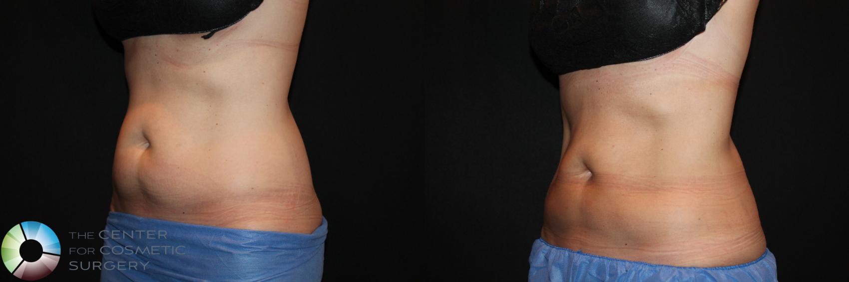 Before & After CoolSculpting Case 729 View #1 in Denver and Colorado Springs, CO