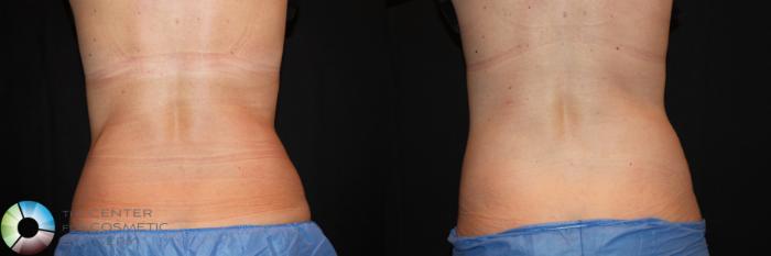 Before & After CoolSculpting Case 729 View #2 View in Golden, CO