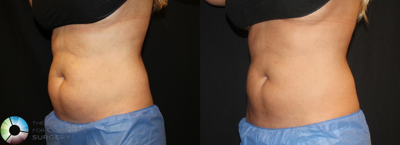 Before & After CoolSculpting Case 730 View #1 in Denver and Colorado Springs, CO