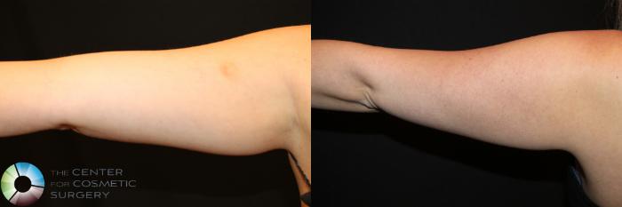 Before & After CoolSculpting Case 731 View #1 in Denver and Colorado Springs, CO