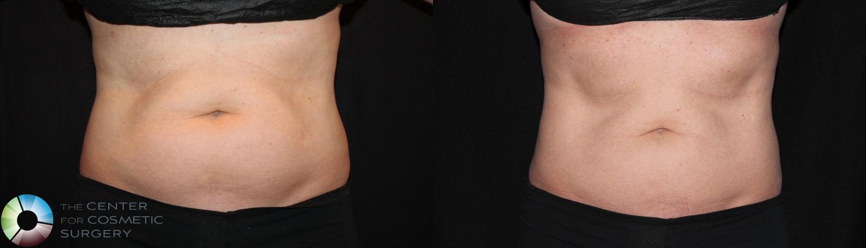 Belly Fat Removal Colorado Springs - CoolSculpting On Abdomen