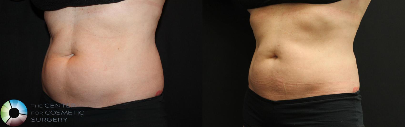 Before & After CoolSculpting Case 735 View #2 View in Golden, CO