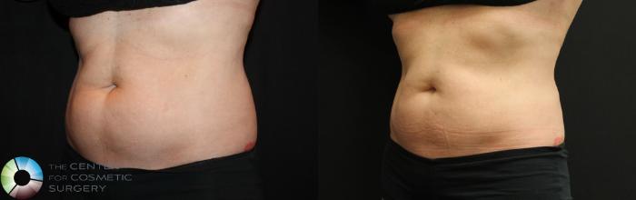 Before & After CoolSculpting Case 735 View #2 in Denver and Colorado Springs, CO