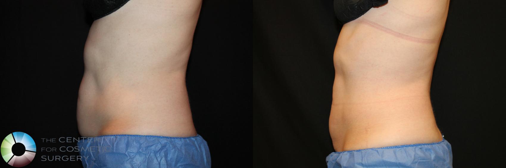 Before & After CoolSculpting Case 736 View #1 in Denver and Colorado Springs, CO