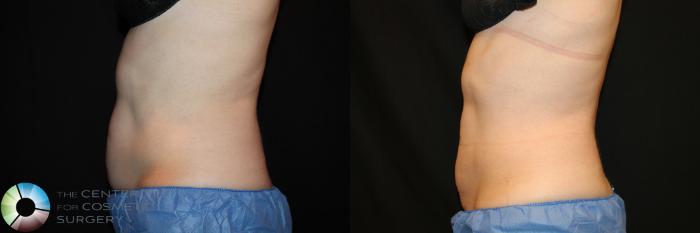 Before & After CoolSculpting Case 736 View #1 View in Golden, CO