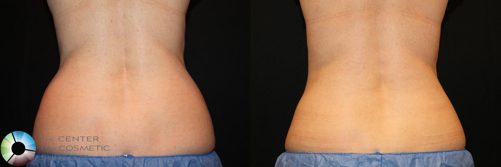 Before & After CoolSculpting Case 737 View #1 in Denver and Colorado Springs, CO