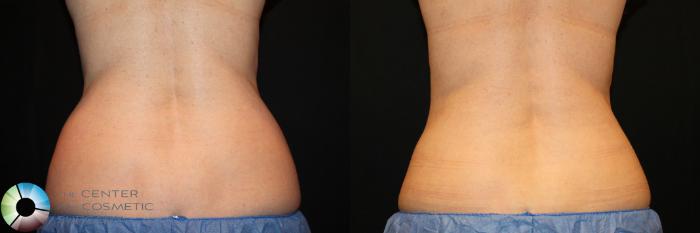 Before & After CoolSculpting Case 737 View #1 View in Golden, CO