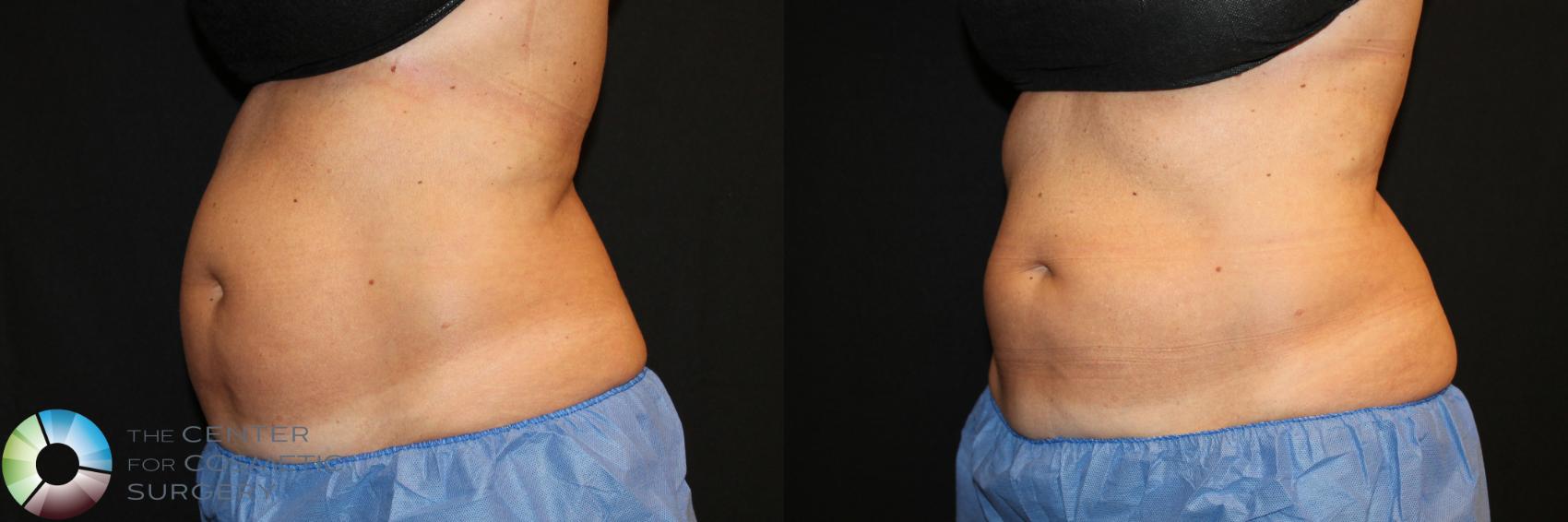 Before & After CoolSculpting Case 738 View #1 in Denver and Colorado Springs, CO