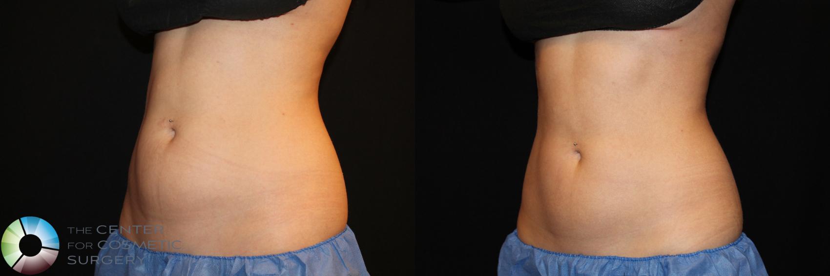 Before & After CoolSculpting Case 743 View #1 in Denver and Colorado Springs, CO