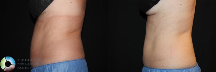 Before & After CoolSculpting Case 745 View #1 View in Golden, CO